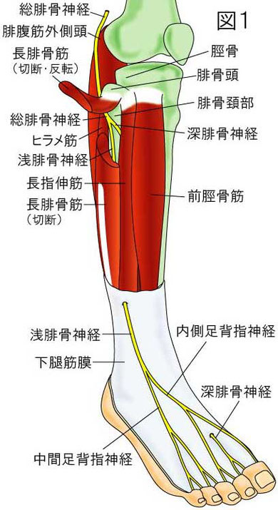 腓骨神経　絞扼部位