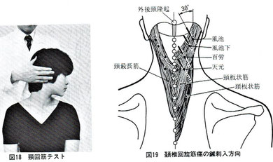 木下晴都：回旋時の痛みは頚椎外方30度で刺鍼。