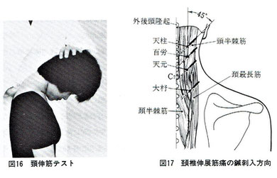 木下晴都：伸展時の痛みは頚椎内方45度で刺鍼。