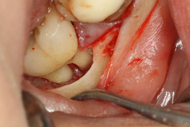 歯周病で骨の吸収が起きた状態