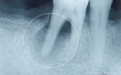 Entzündung an der Wurzel eines abgestorbenen Zahnes im Röntgenbild