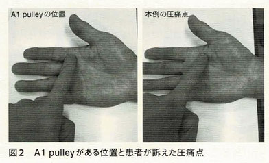 A1 pulleyの位置と正しい圧痛点