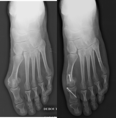 hallux valgus cirugía chevron Akin tornillos Toulouse dr Rémi chirurgie orthopédique La Croix du Sud