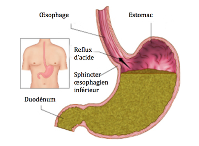 Dessin estomac et acide gastrique