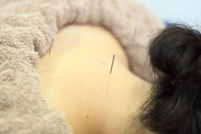 女性鍼灸で美肌と体質改善