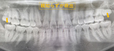矯正治療により出っ歯と歯のがたがたは治り良い咬合になった。奥歯の後ろに親知らずが生えて嚙めるようになります。