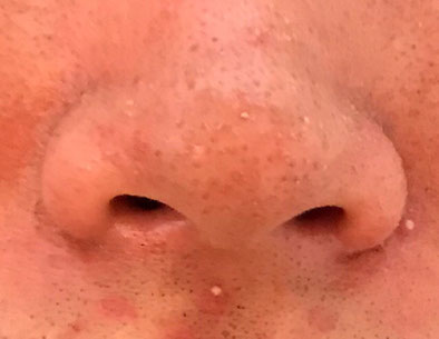 脂漏性皮膚炎　写真　サロンドノム
