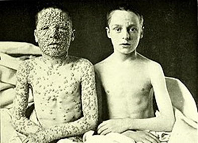 Bild zweier Dreizehnjähriger, die sich mit Pocken infiziert haben. Der rechte Junge war als Kind gegen die Krankheit geimpft worden. Quelle: Gemeinfrei, via Wikimedia Commons, Foto: Alan Warner. In: Atlas of Clinical Medicine, Surgery, and Pathology 1901.