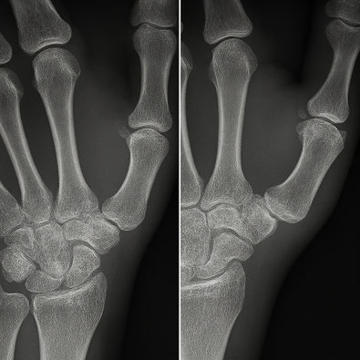 gesundes und arthrotisches Daumensattelgelenk - Rhitzarthrose