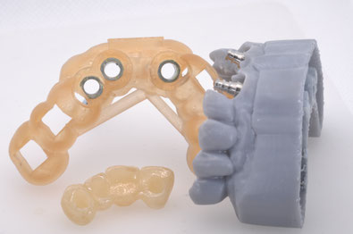 Chirurgia Guidata-3shape Implant studio-Realguide-Provvisorio a carico immediato