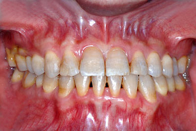 画像：　テトラサイクリン着色歯の人の歯列矯正 保定装置 DP