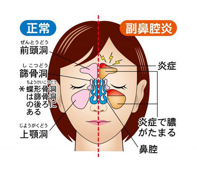 慢性副鼻腔炎イラスト