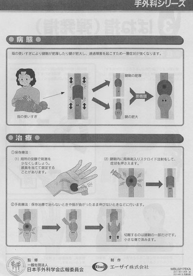 【バネ指】釣りのし過ぎ、シャクリ過ぎ