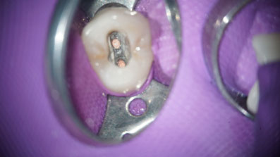 Kofferdamm Mikroskop Endodontie