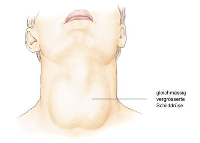 Animiertes Bild einer Person mit einer vergrösserten Schilddrüse