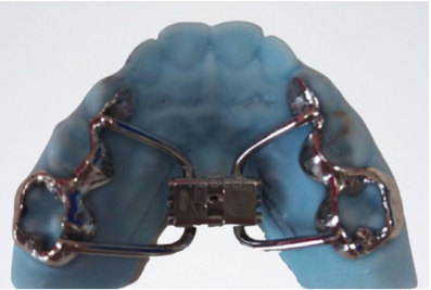 espansore palatale per allargare il palato