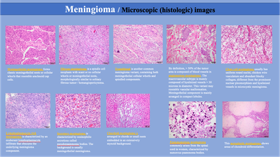 10つの髄膜腫の組織学的亜型のプレパラート写真