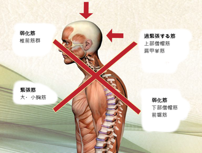 上位交差症候群