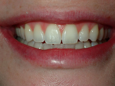 Veneers, Cosmetic dentist spanish fork