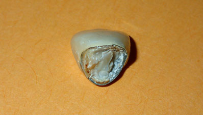 All the tooth is stuck in the broken off crown