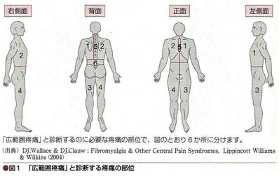 広範囲疼痛と診断する疼痛の部位