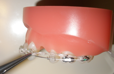 成長期に行う矯正治療、正中離開・側切歯の反対被蓋の改善