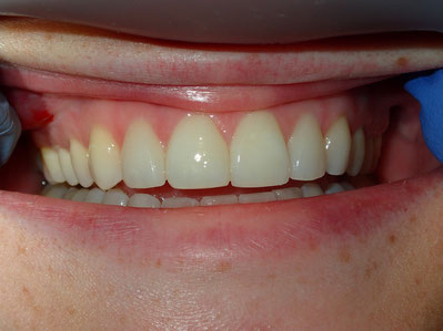 Cosmetic Dentist Spanish Fork, Veneers