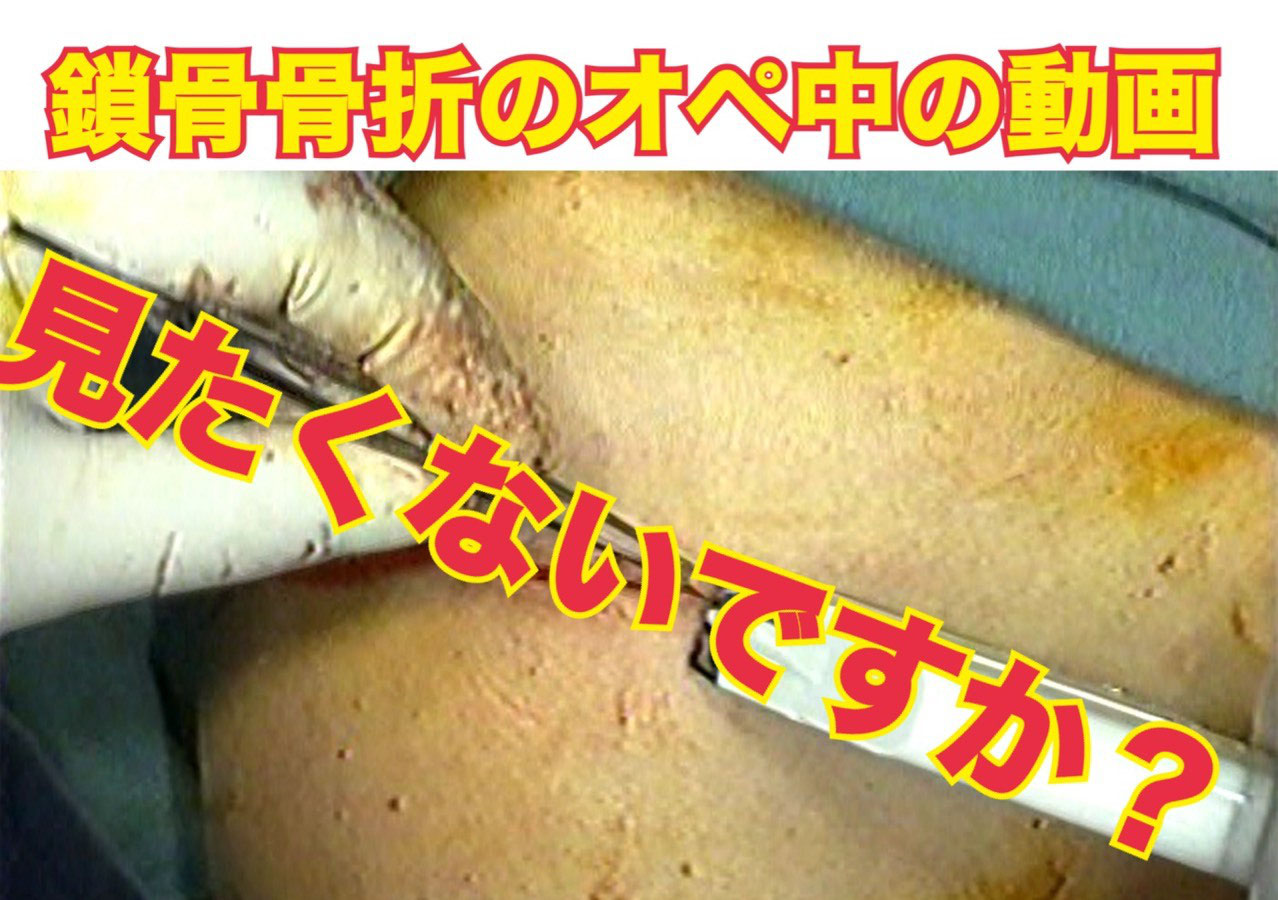 鎖骨外端骨折のオペ中の動画 みたくないですか 鍼灸師 柔道整復師の為の整形外科学研究会