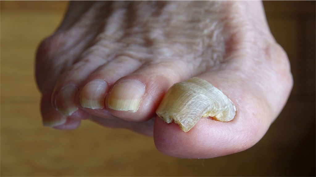 高齢 者 足 の 爪