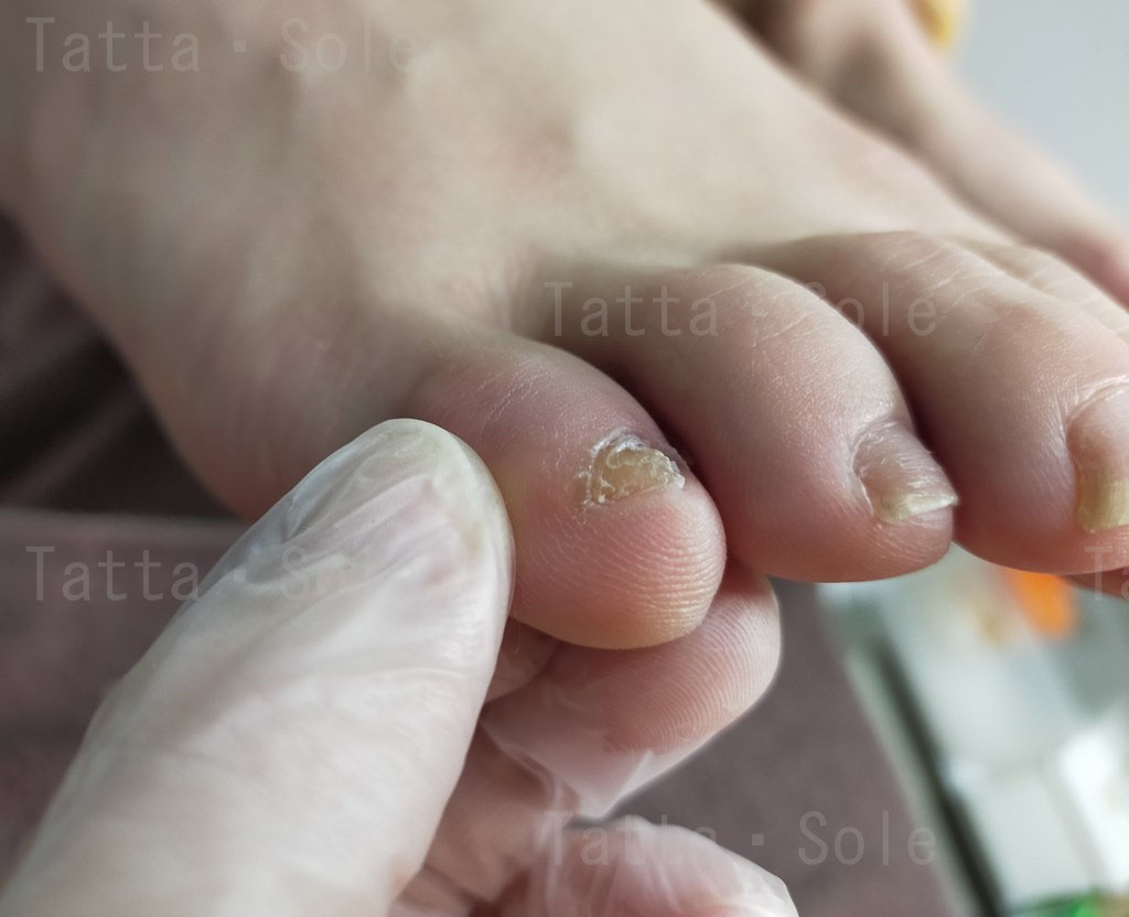 小指の爪がガタガタなのが気になります - タッタ・ソール