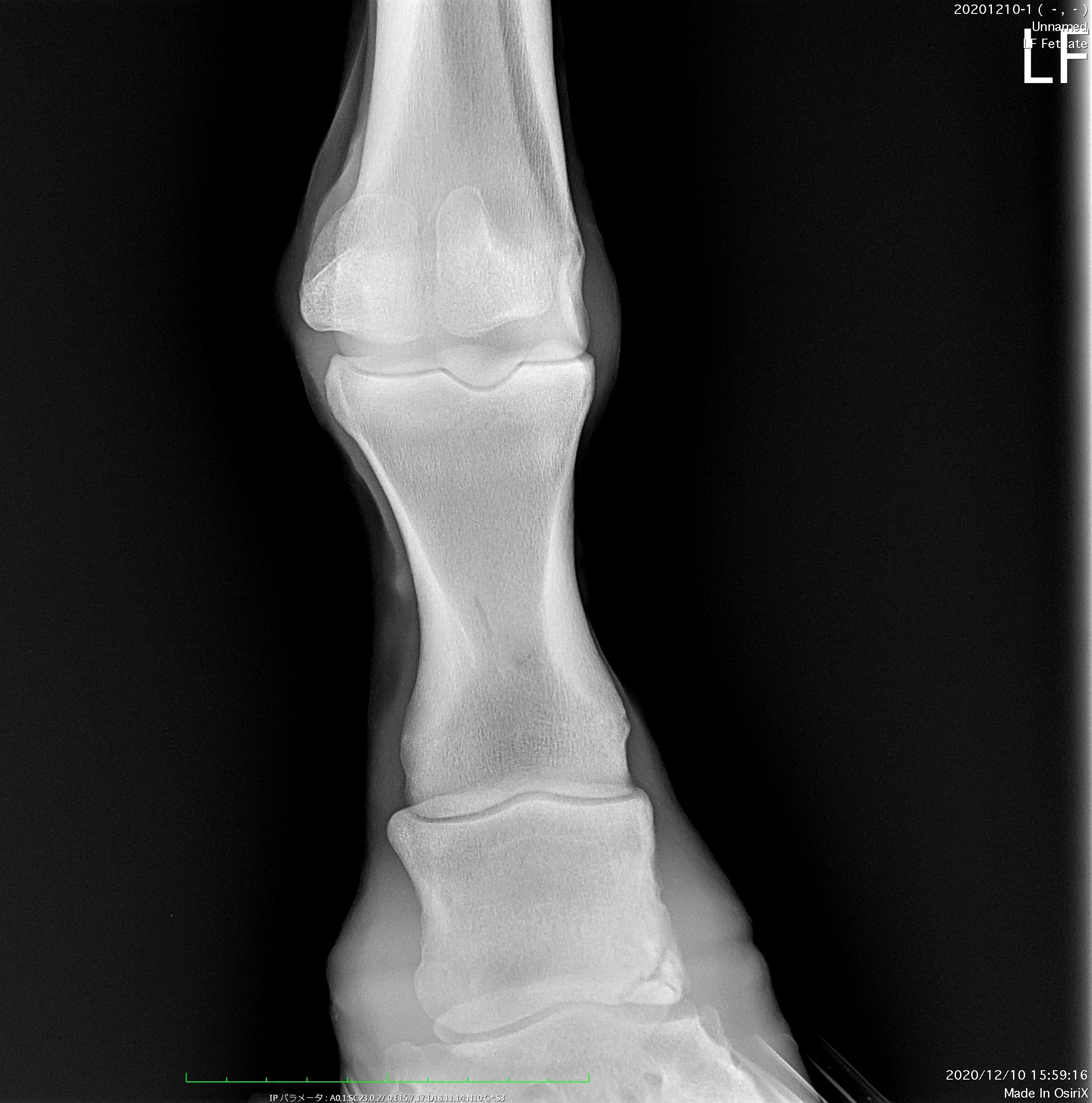 前肢の中節骨遠位における剥離骨折 エルムホースクリニック