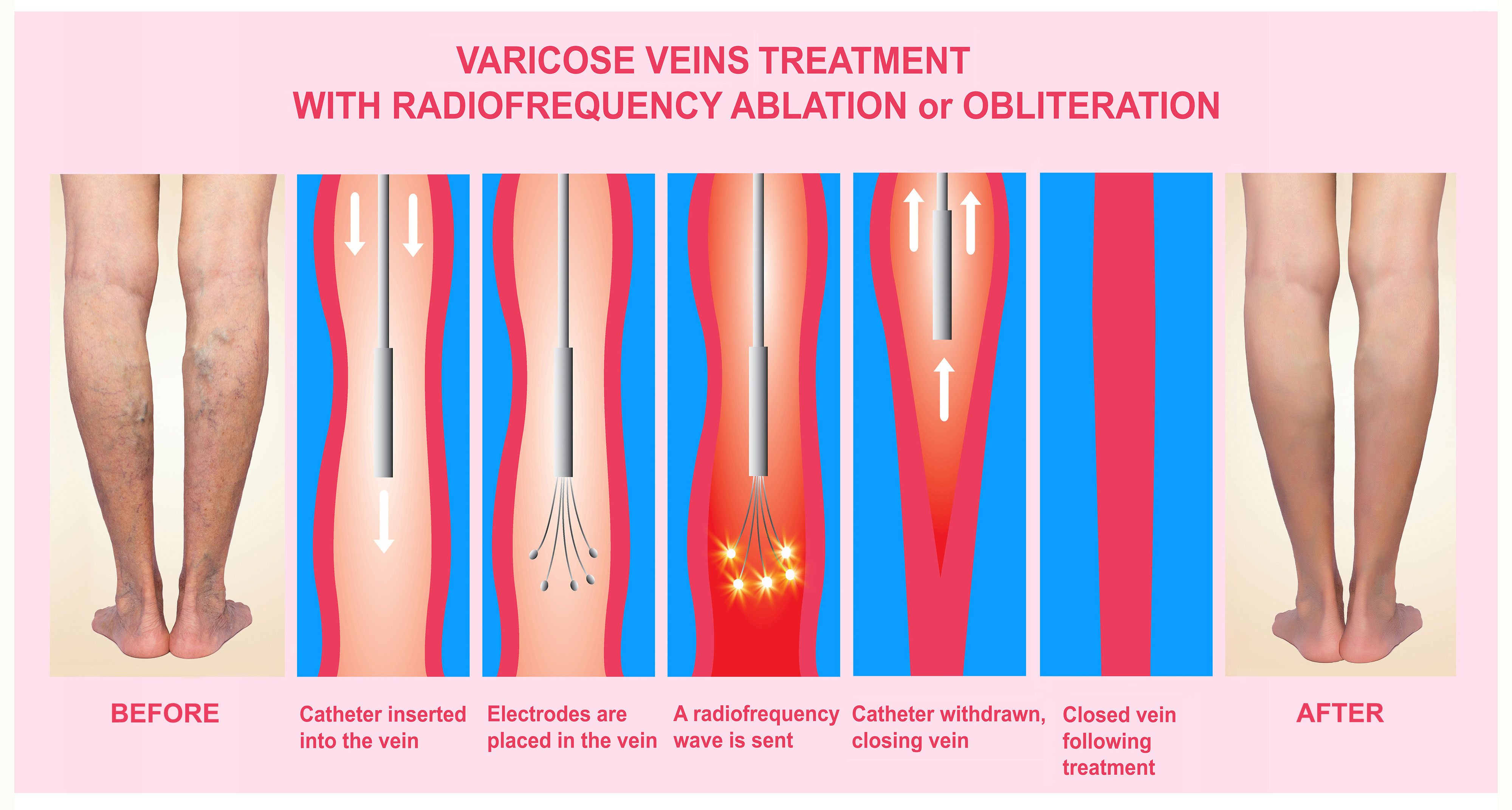 Vein Treatment Varicose Vein Treatment Truffles Vein Specialists