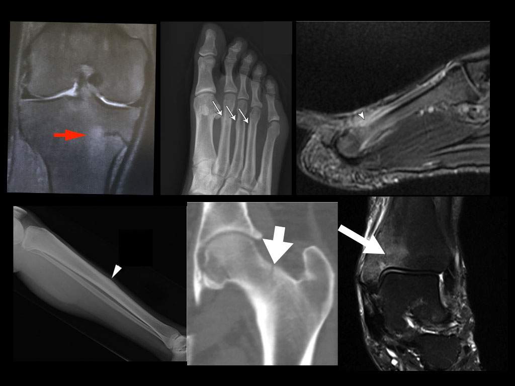 FRACTURE DE FATIGUE Dr Rémi chirurgien orthopédiste à Toulouse