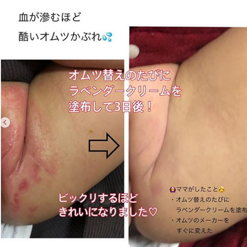 オムツかぶれにはラベンダークリーム Sakuraview オムツかぶれにはラベンダークリーム Sakuraview