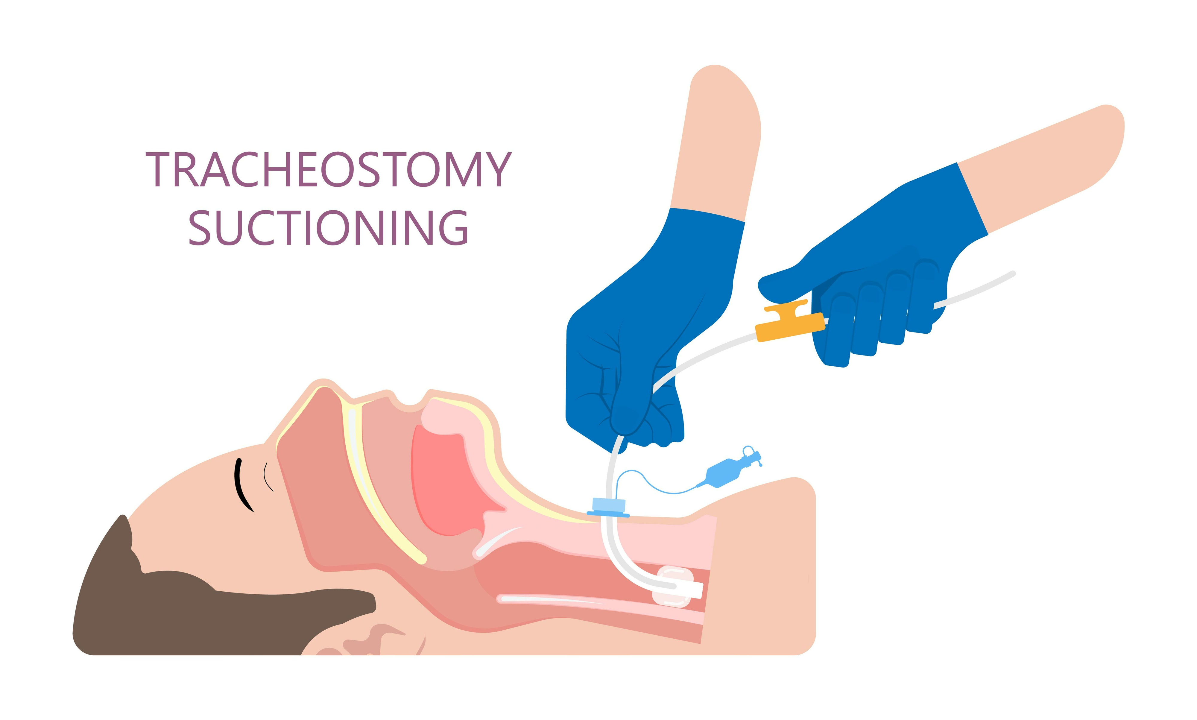 Tracheostoma infomqlbildungs seite!