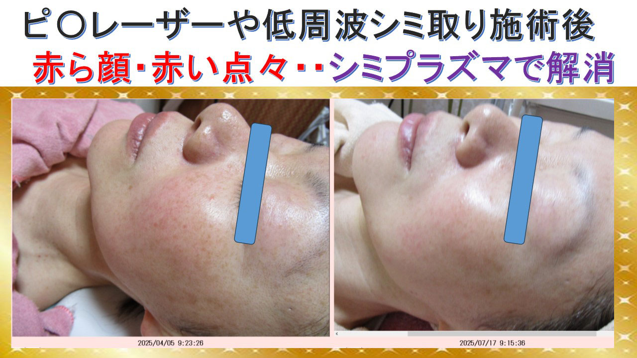 ピ〇レーザーや低周波シミ取り施術後 赤い顔・赤い点々