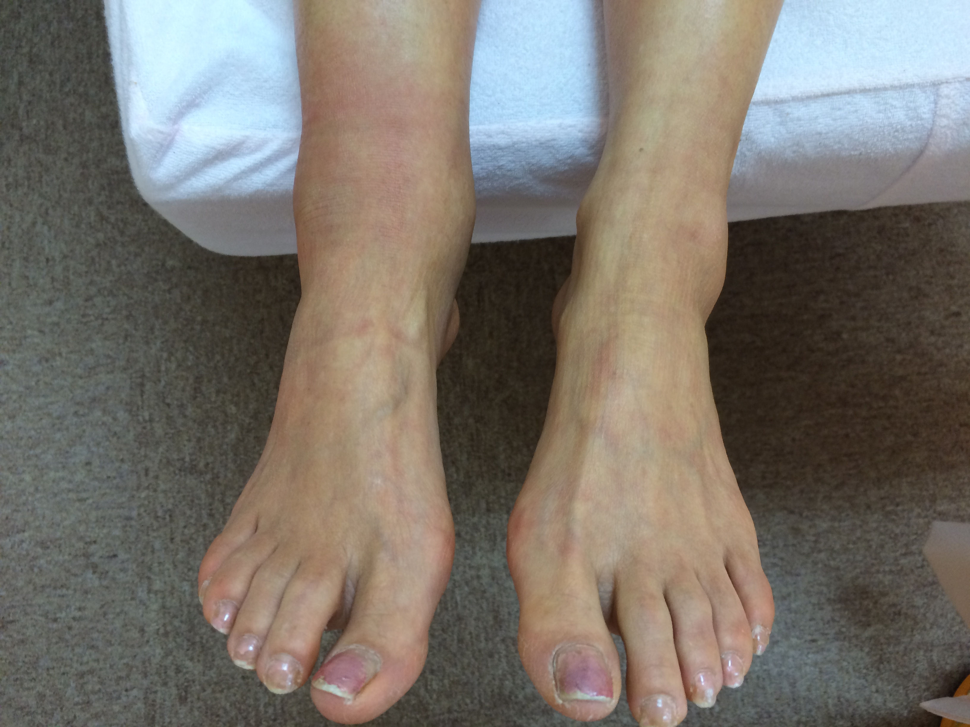 右足関節脱臼骨折 接骨院 豊田市 骨折 脱臼 スポーツ外傷 交通事故