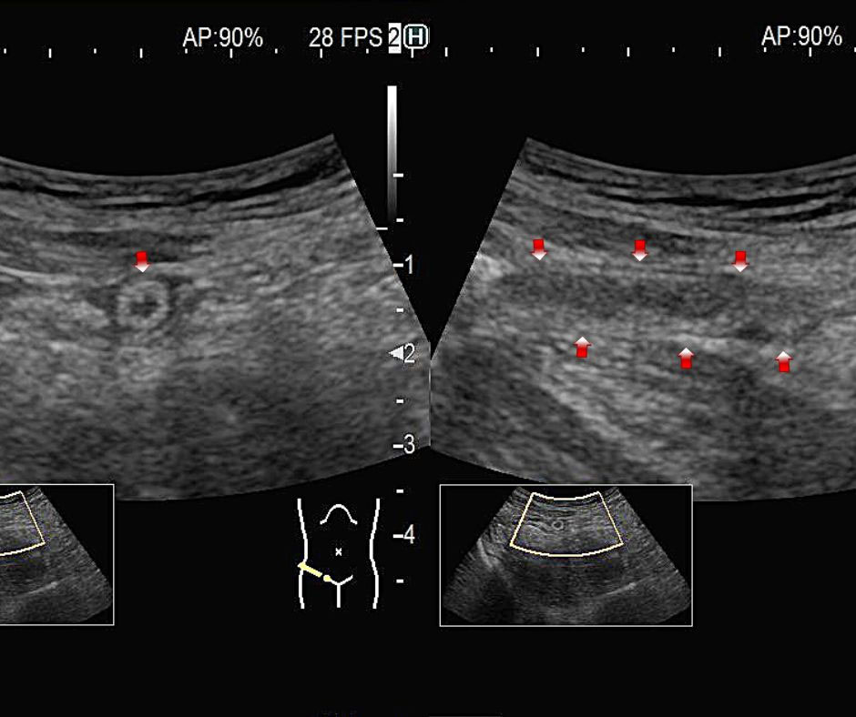 虫垂炎を読み解く 虫垂炎を読み解く | 根東 順子 |本 | 通販 | Amazon