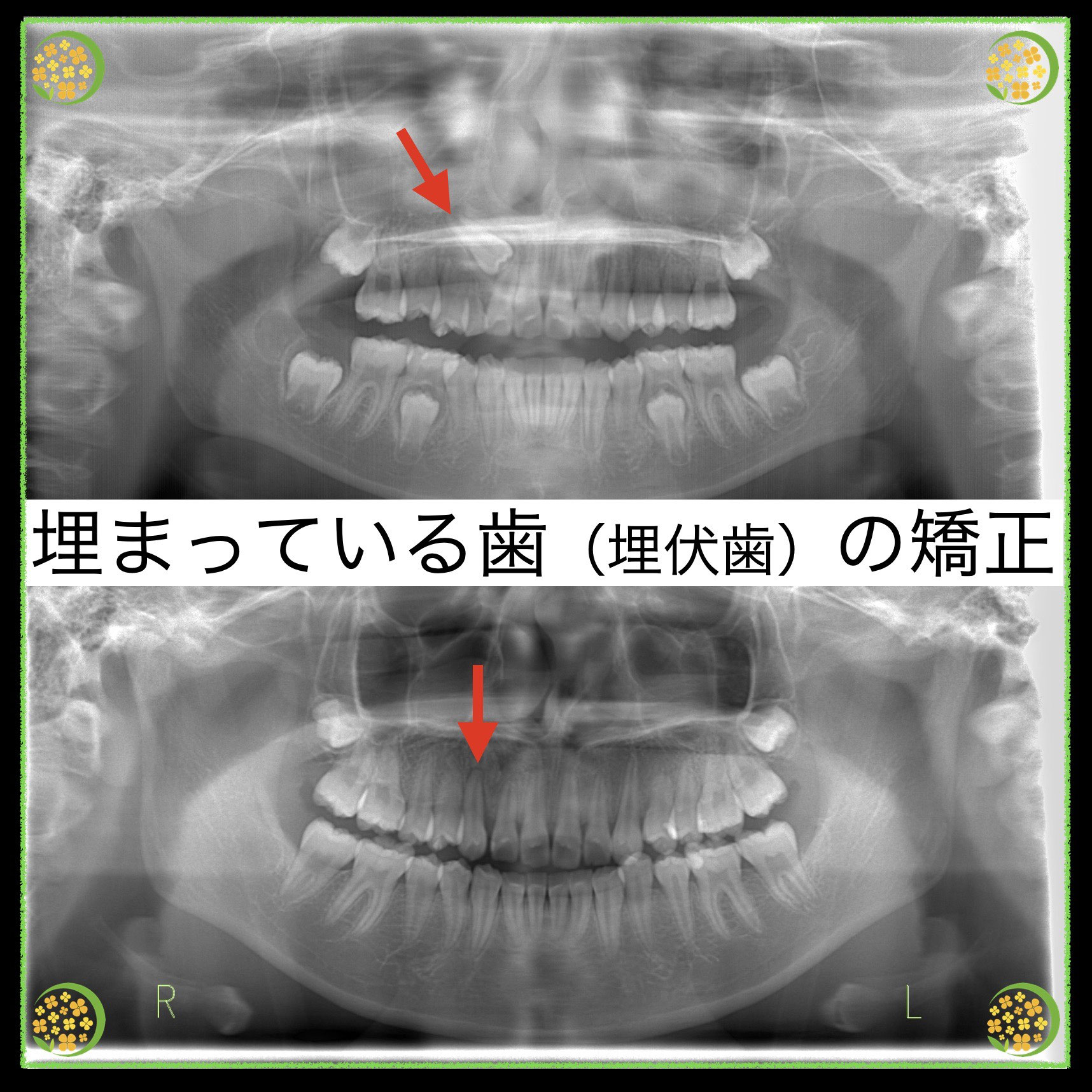 抜歯しない埋伏歯の矯正歯科治療 | 野田 隆夫, 野田 雅代 |本