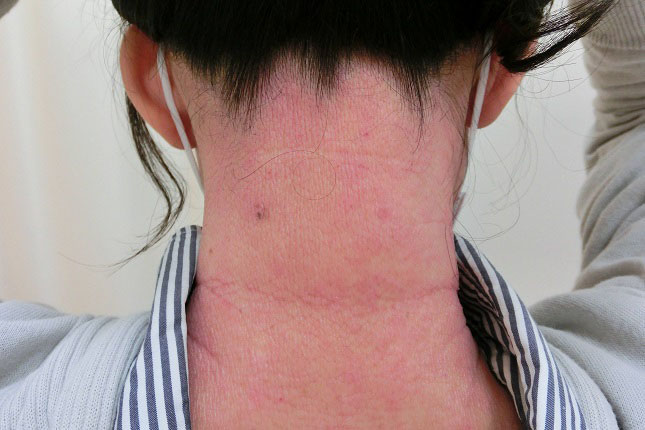 フケじゃなかった 脱毛にもつながる脂漏性皮膚炎のナゾ アトピー発症機序理論4 日本アレルギーリハビリテーション協会 フケじゃなかった 脱毛にもつながる脂漏性皮膚炎のナゾ アトピー発症機序理論4 日本アレルギーリハビリテーション協会