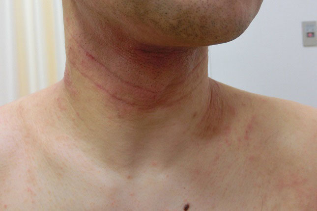 スマホの普及で顔の湿疹が増えた アトピー発症機序理論5 日本アレルギーリハビリテーション協会