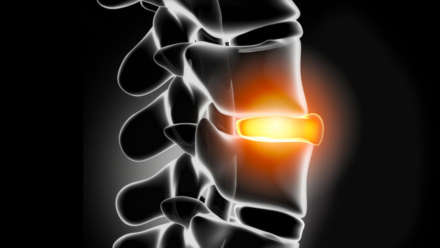 Bandscheibenvorfall? Das muss nicht sein! - feel-the-balance
