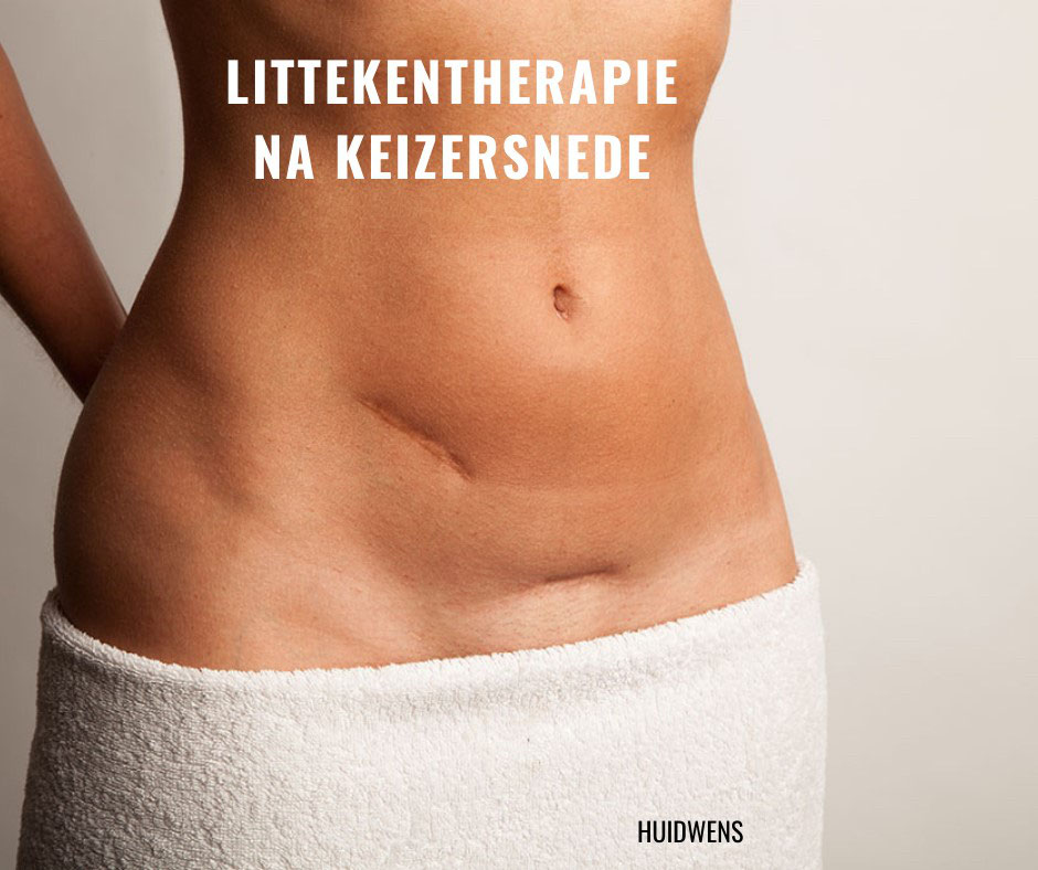 Littekentherapie na keizersnede - HuidWens Littekentherapie Na Keizersnede - Huidwens