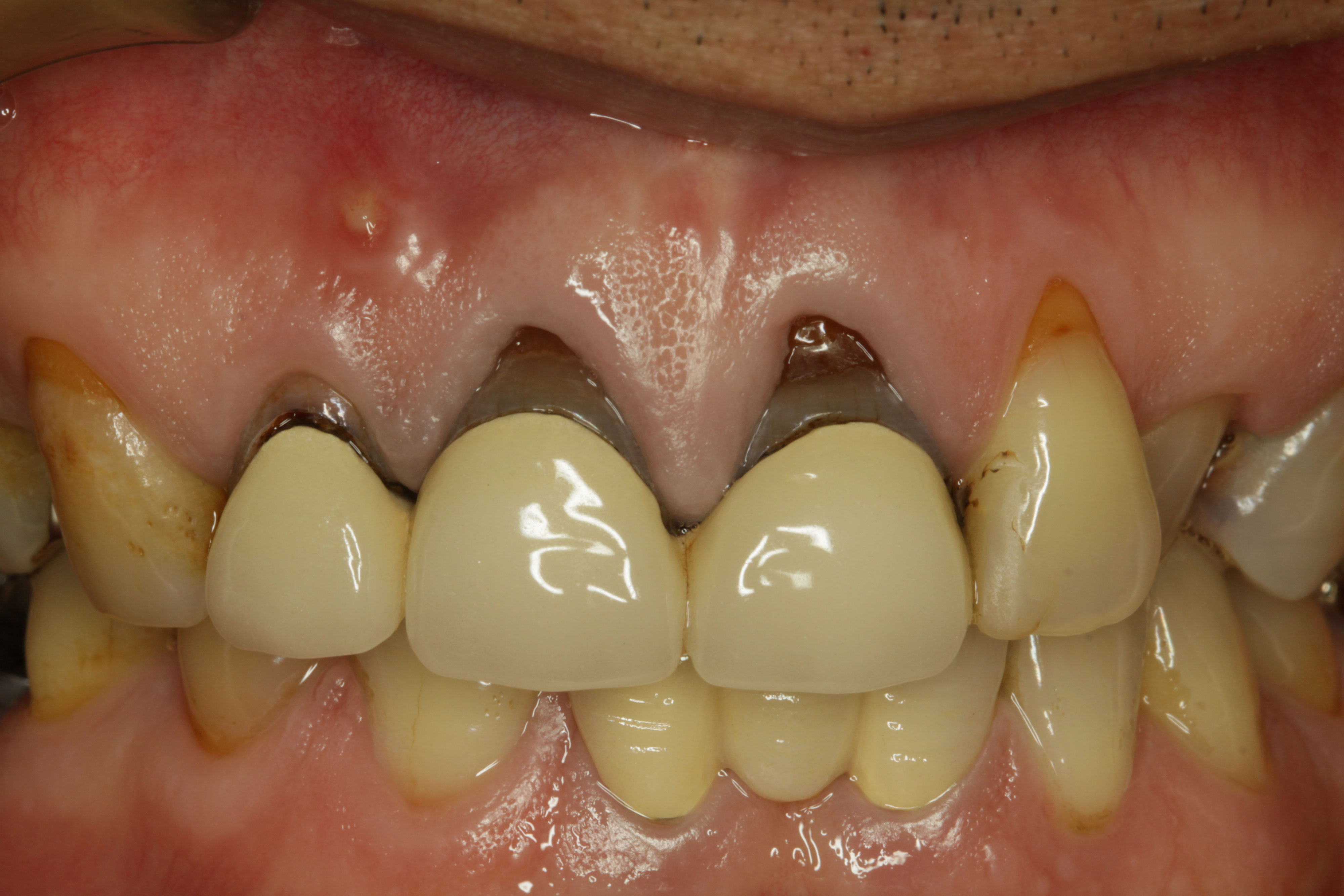 歯茎の黒ずみ 審美歯科の専門ページ