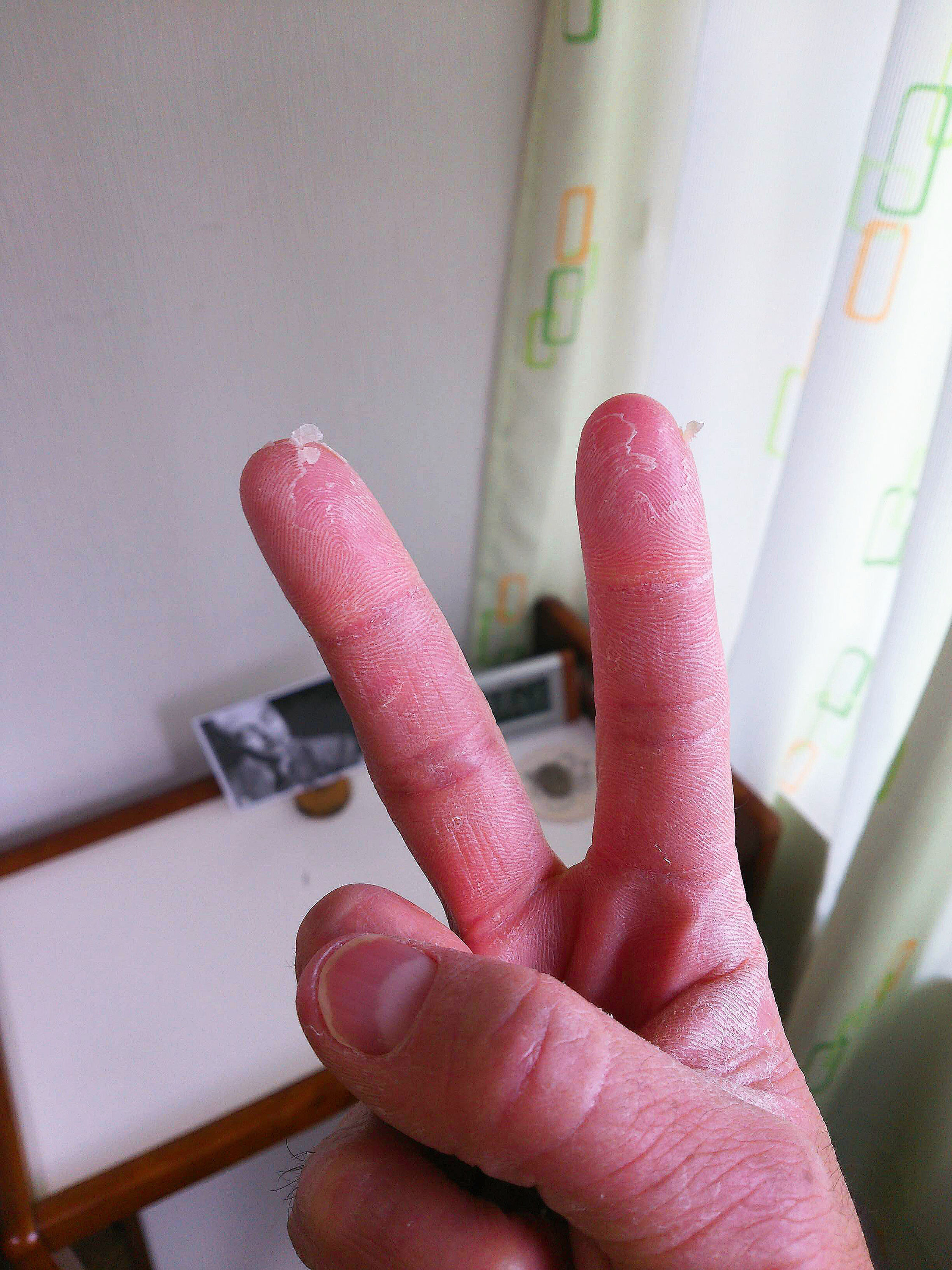 指の皮がむけた 名古屋でジャズベースを習うなら エレキベース ウッドベース コントラバスはみんな 高間康弘ジャズベーススクール へ