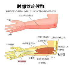 肘部管症候群について - がじゅまるカイロプラクティック湘南台