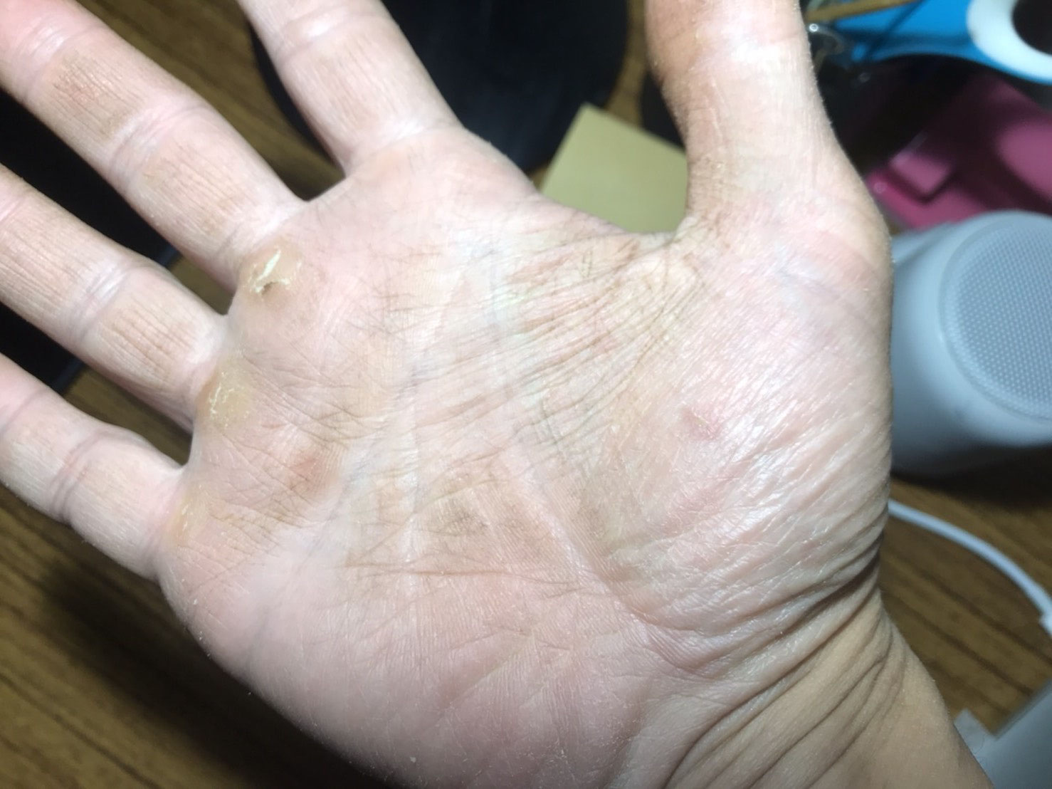 手荒れがひどい 僕らの移住生活 手荒れがひどい 僕らの移住生活