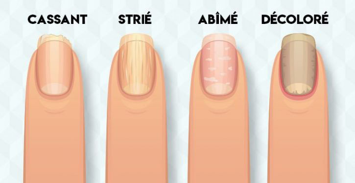 Comment Détecter Des Problèmes De Santé Dans Vos Ongles