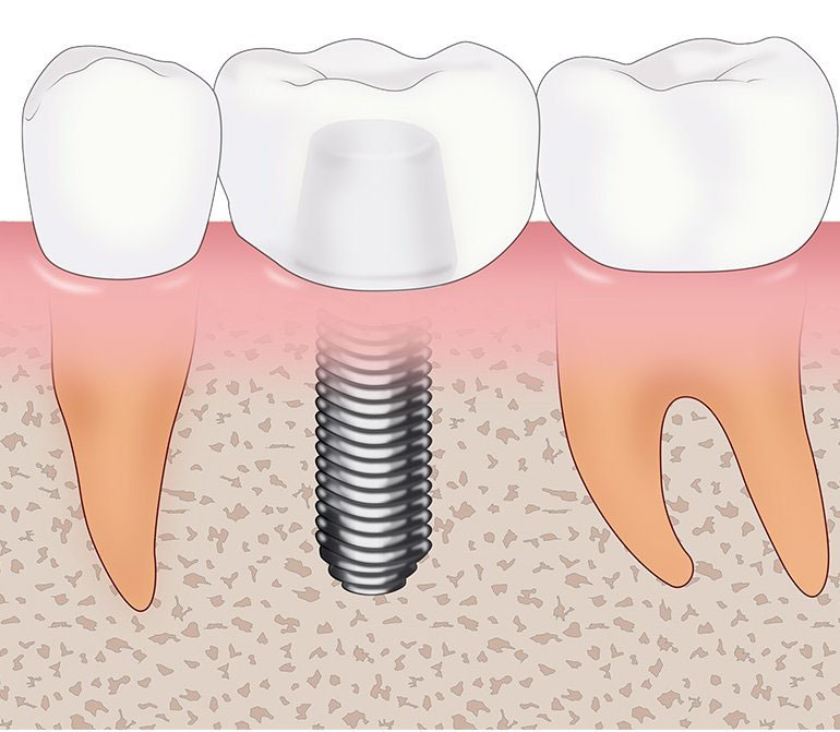 Dr.皆川の インプラント治療における軟組織移植術【全3巻・分売不可】 Dr.皆川の インプラント治療における軟組織移植術【全3巻・分売