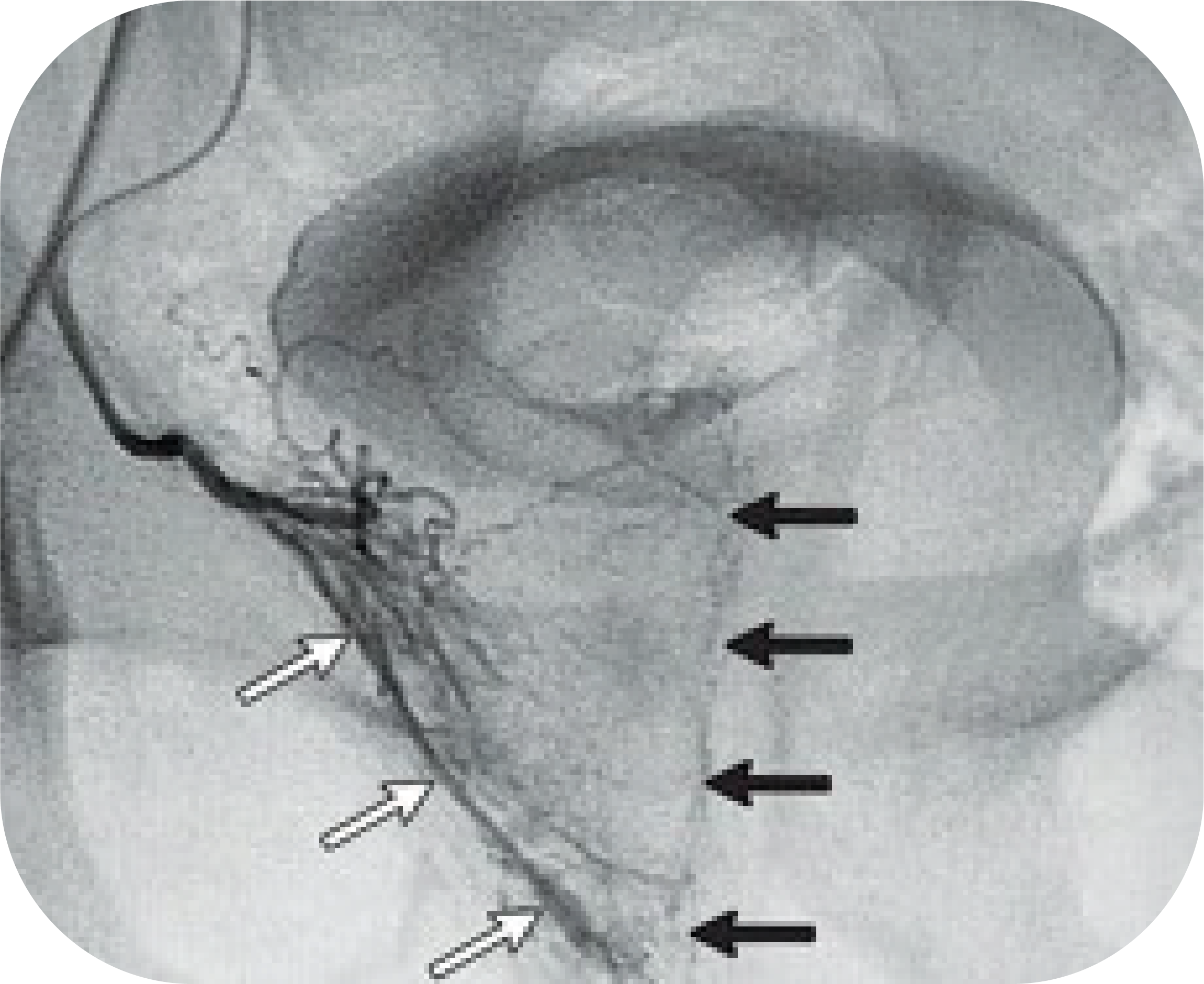 embolizzazione prostata niguarda milano